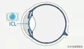 医生戴着眼镜讲近视手术的好处,没戴过眼镜适合做近视手术吗