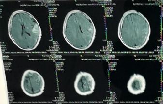 开车撞到人重伤后期的赔付多少钱,车祸造成腔隙性脑梗塞算几级伤残