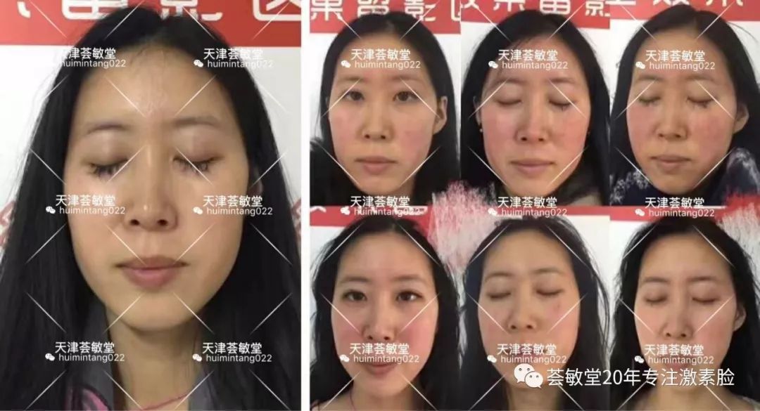 激素脸敏感专用护肤品,激素脸护肤品推荐排行