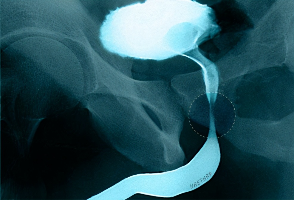 前列腺肥大并钙化灶什么症状,年轻人有前列腺肥大