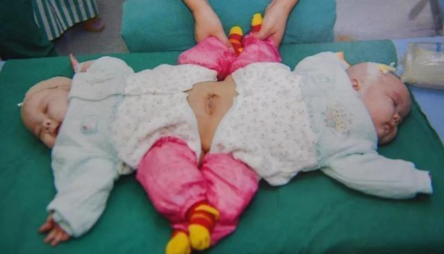 国内首例连体双胞胎,坐骨连体双胞胎女孩现状