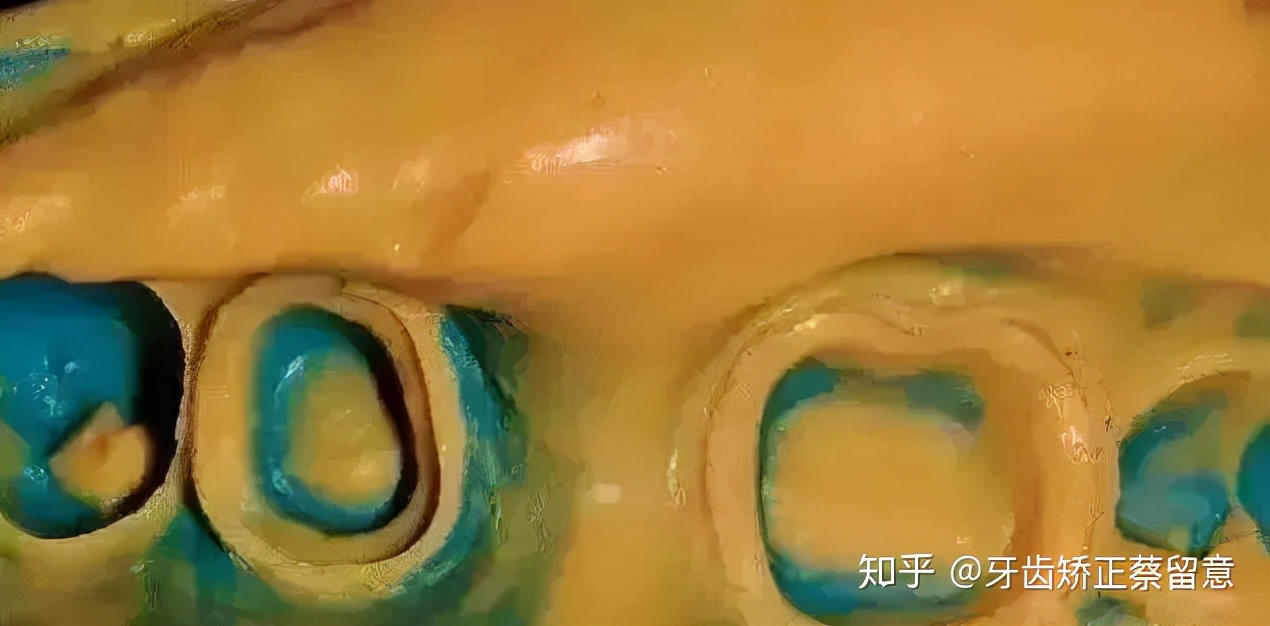 全瓷牙冠戴好了感觉咬合高了,戴了牙冠感觉大牙咬合不住