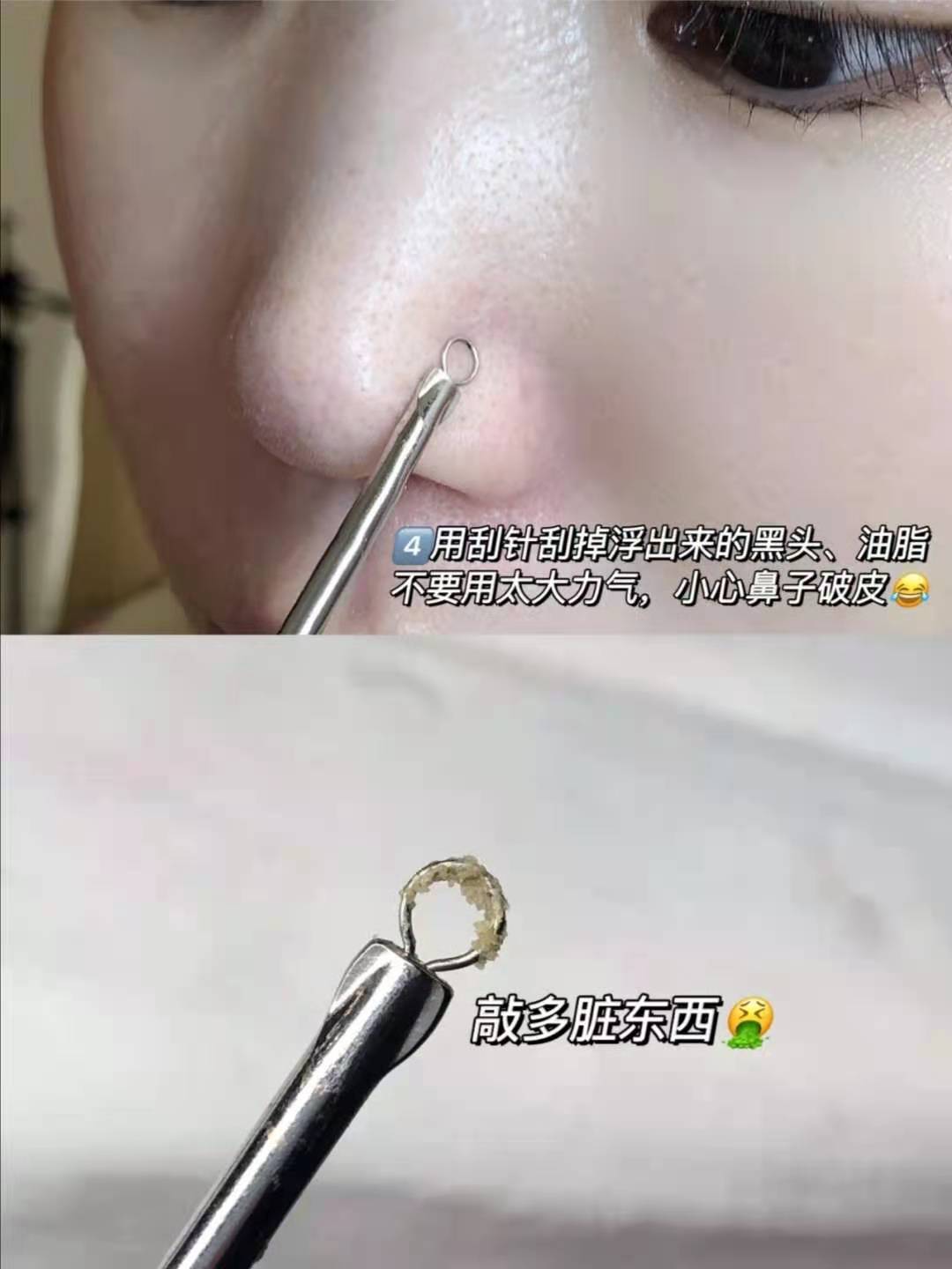 去黑头收缩毛孔的最好方法甲硝唑,男士去黑头收缩毛孔洗面奶