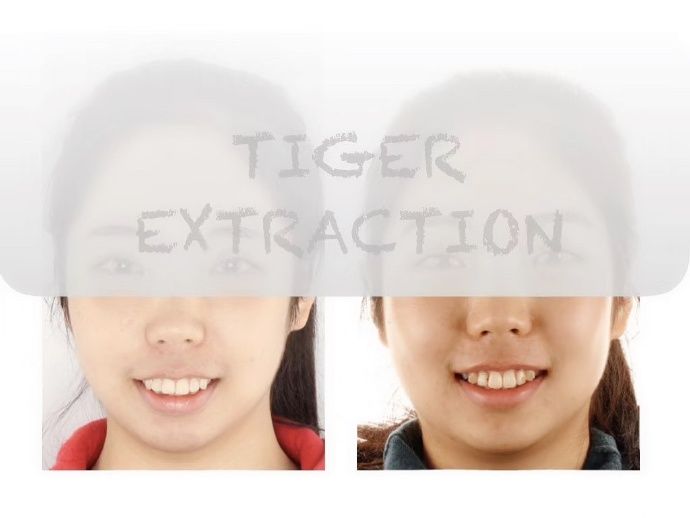 牙齿矫正南京哪家医院比较好,牙齿代偿性矫正