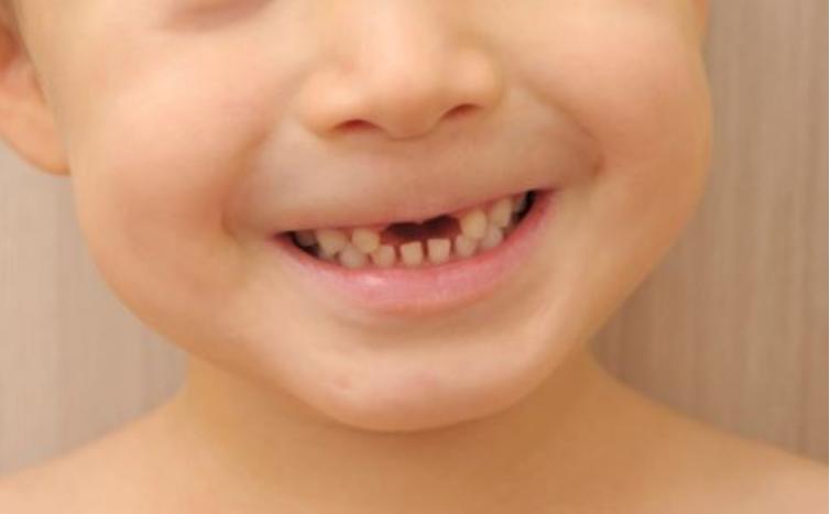 3岁儿童龋齿怎么办,3周小孩龋齿吃什么预防