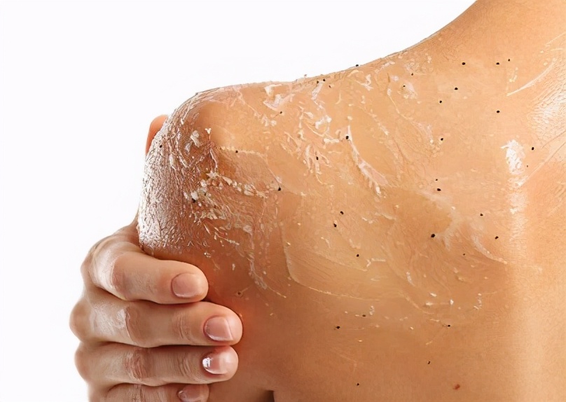 长痘女生的痛苦,体会长痘的痛苦