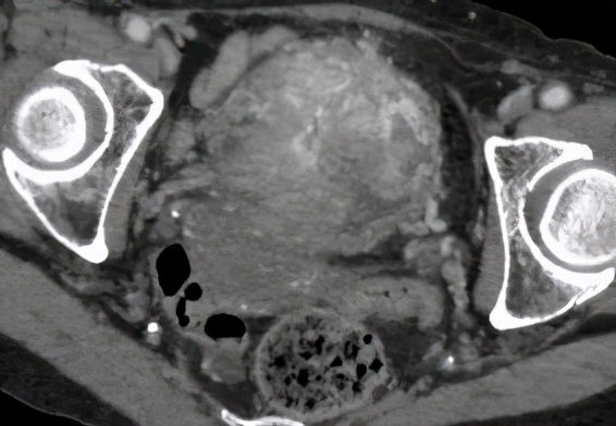 膀胱肿瘤患者吃什么保健品,膀胱肿瘤特效药