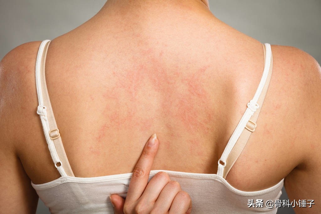 犬异位性皮炎症状,什么是异位性皮肤病