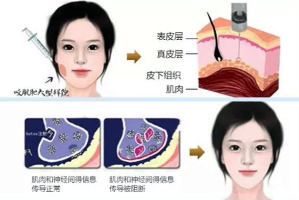 打了三次瘦脸针想告诉你这些真相,刚打了瘦脸针后悔了有补救吗