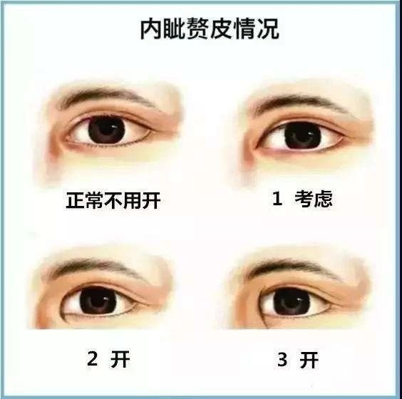 开眼角真的能变漂亮吗,关于开眼角你都了解什么