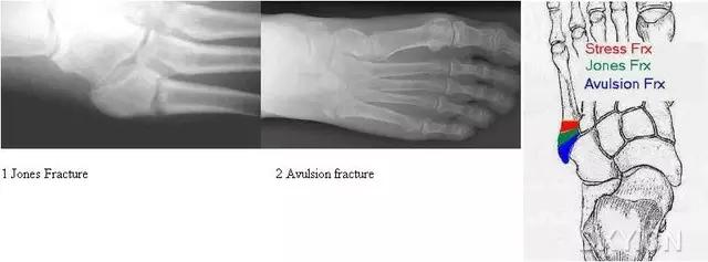 特殊骨折类型,特殊骨折体征