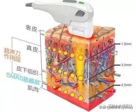 热玛吉超声刀光子嫩肤,超声炮热玛吉光子嫩肤的区别