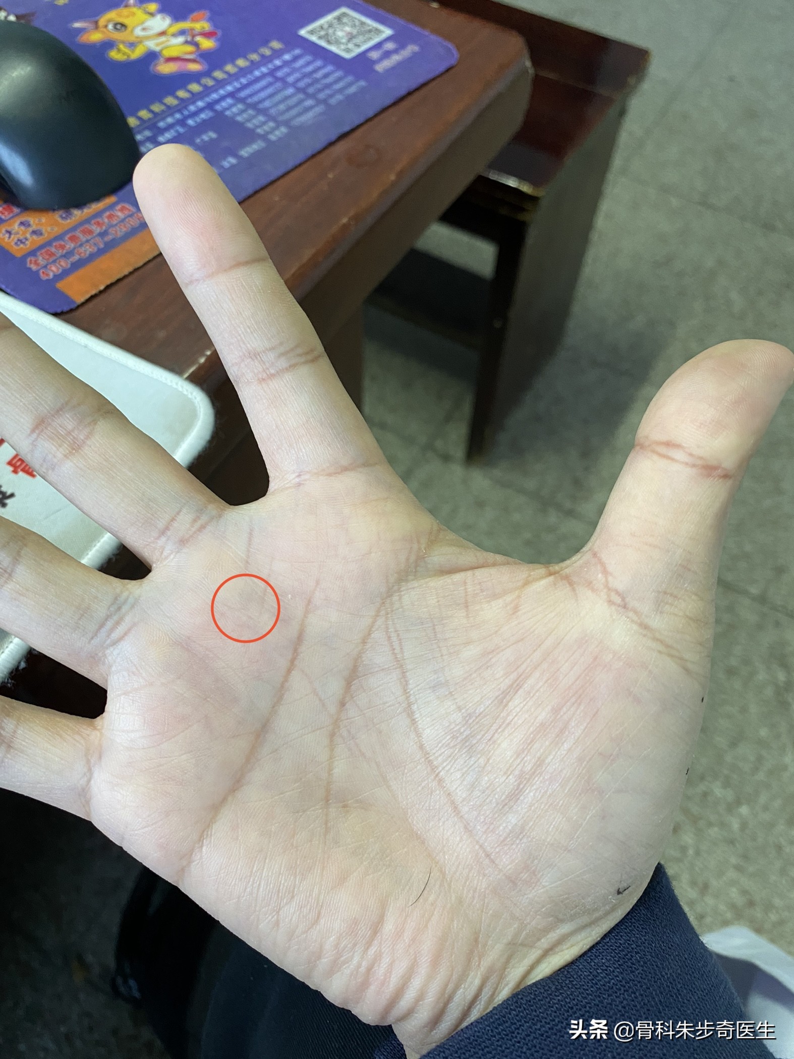 患者故事:今天说说,腱鞘炎究竟应该怎么治疗?需要不需要手术?