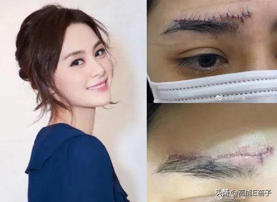 阿娇额头伤口恢复过程,阿娇晒伤口恢复照