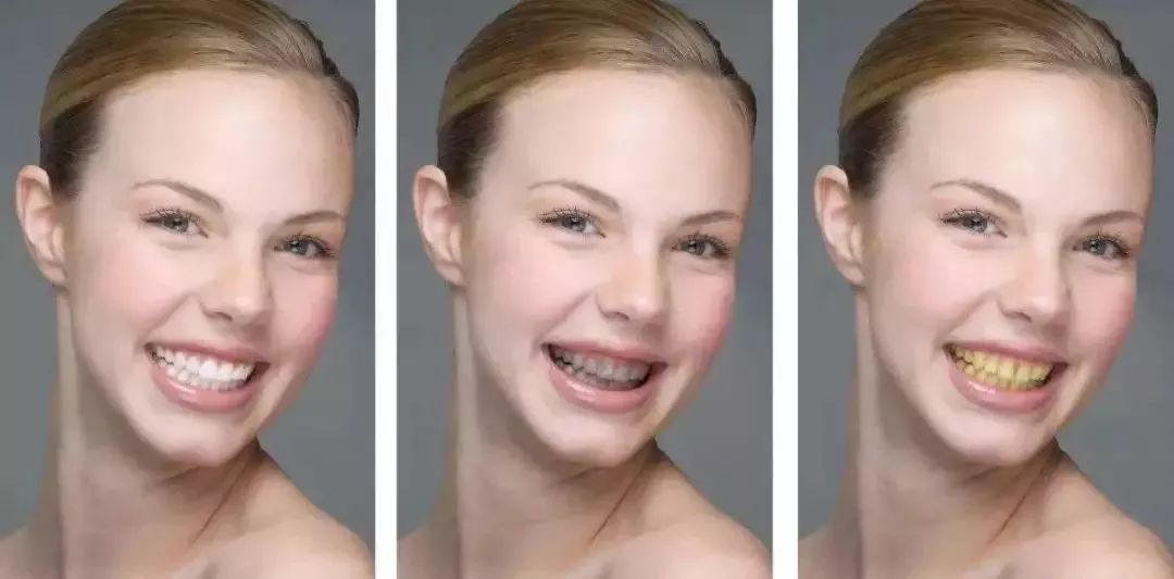 刘涛是全口瓷牙,演员刘涛的一口烤瓷牙多少钱