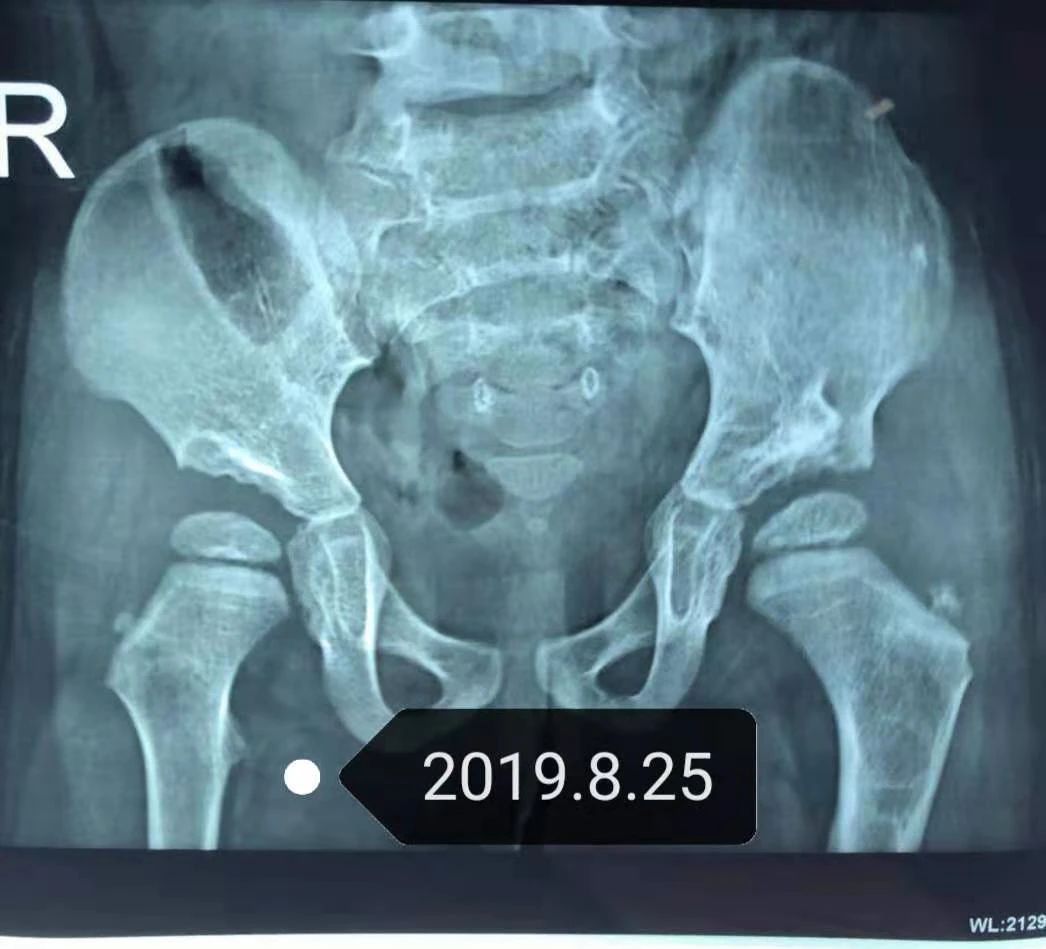 髋关节脱位宝宝保守治疗是怎样的,髋关节脱位宝宝护理