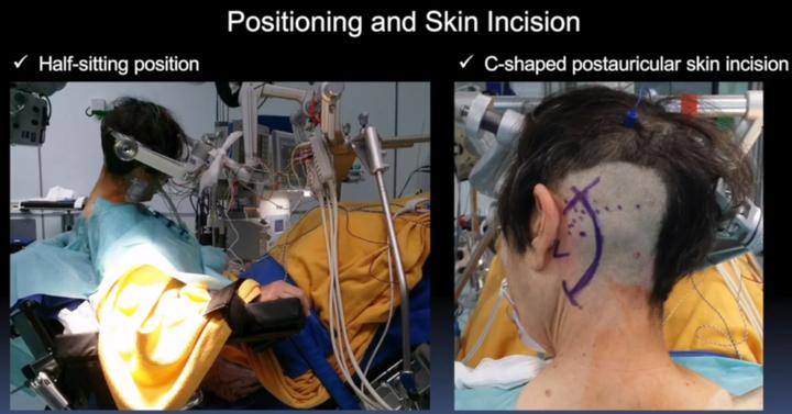 脑干海绵状血管瘤开颅手术,脑干做手术的示意图