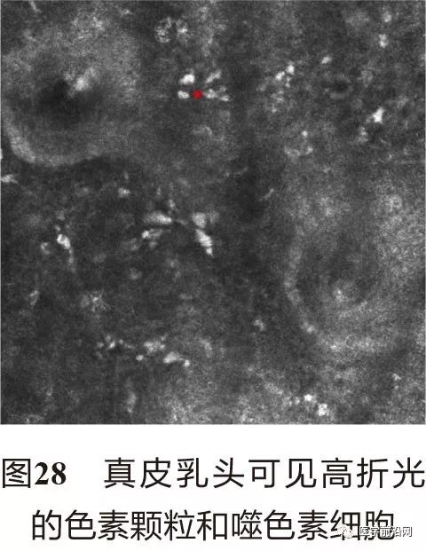 皮肤共聚焦显微镜能查什么,皮肤镜和共聚焦显微镜
