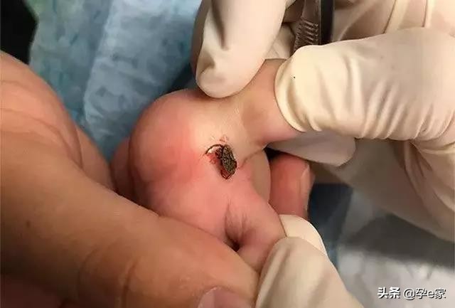 身上出现许多小黑痣,身上出现凸起黑痣一定要重视