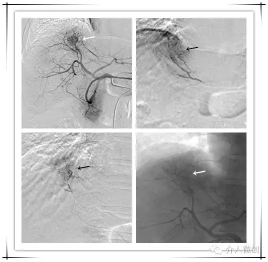 肝癌门静脉癌栓能做介入手术吗,肝癌门静脉癌栓中医治疗