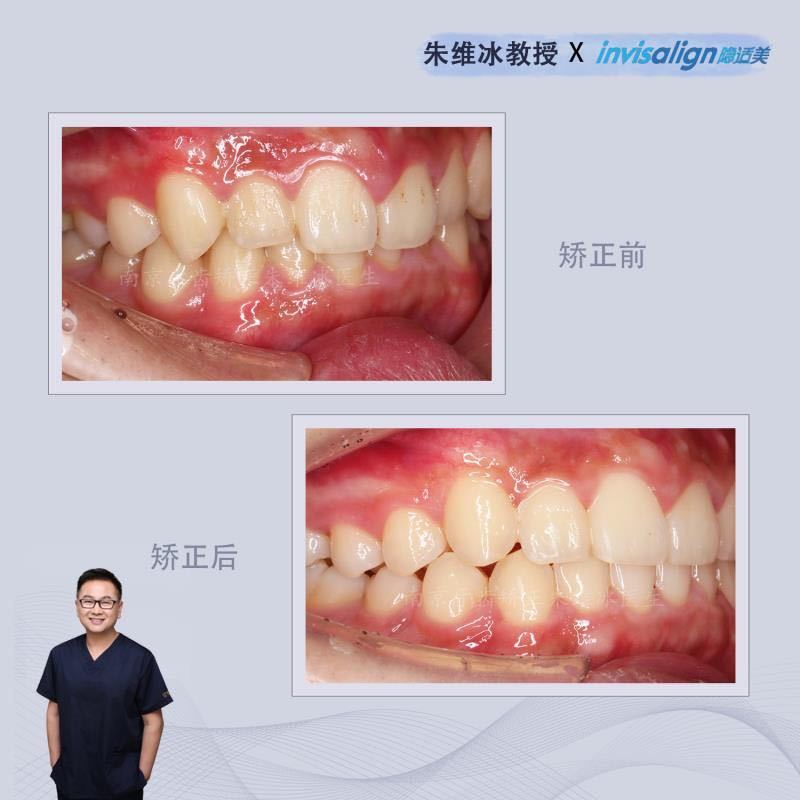 隐适美牙齿拥挤矫正真实案例,南京朱维冰