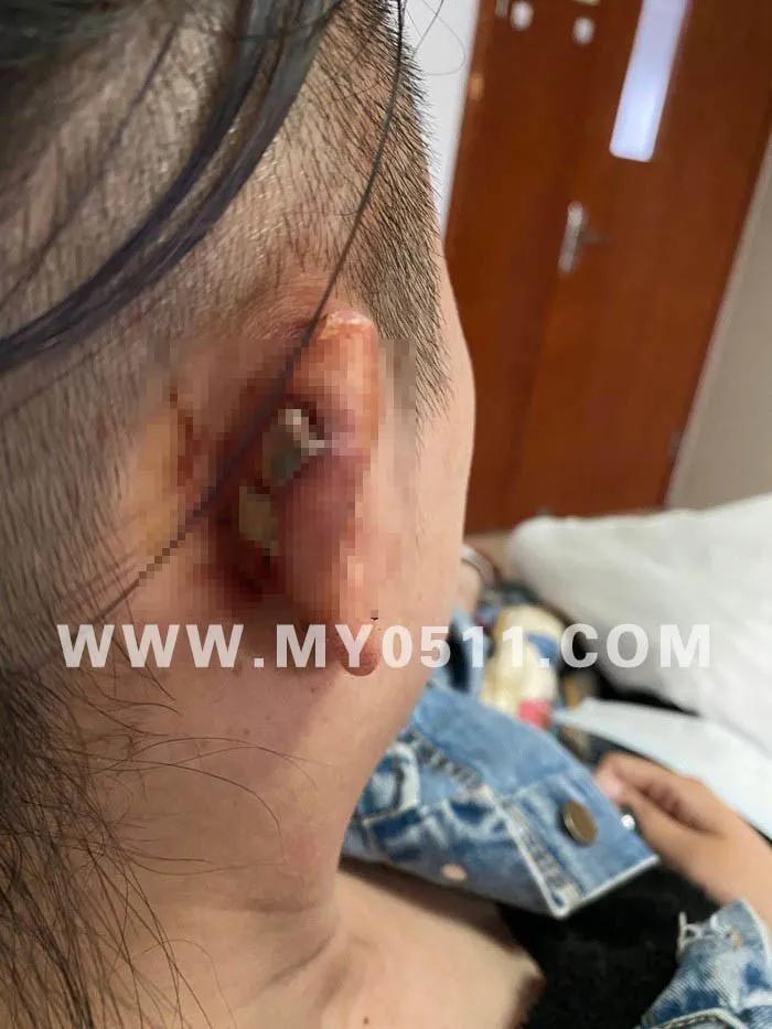 图片慎点！镇江网友打耳洞后发炎感染，耳骨被削，差点畸形