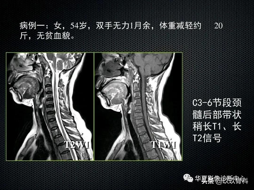 颈椎病脊髓变性mri表现,脊髓亚急性联合变性的诊断