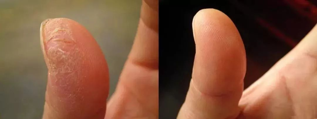 冬季皲裂膏预防脚后跟干裂好用的,上热门脚后跟干裂保湿霜