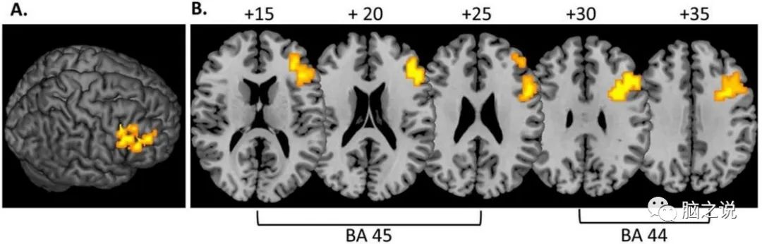 ADHD右侧额下回皮层fMRI神经反馈的功能连接变化