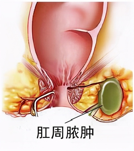 怎么做促进肛周脓肿恢复,如何能帮助肛周脓肿快速吸收