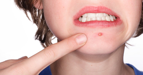 下巴长痘痘的原因以及解决办法,下巴长痘痘怎么办教你一招