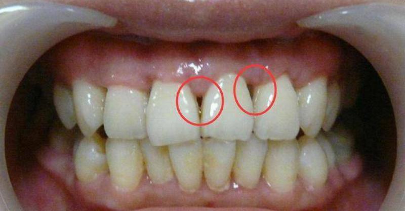 塞牙是小事？不，很可能是病，会掉牙