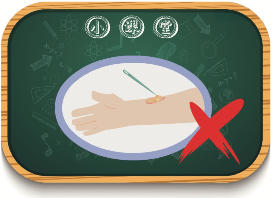 嘴巴烫伤后长水泡怎么处理,浅二度烫伤水泡需要挑破吗