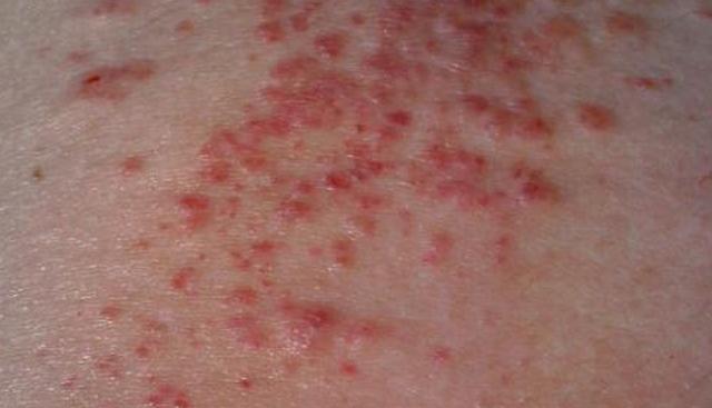 湿疹严重有什么忌口,湿疹过来人的独家秘籍