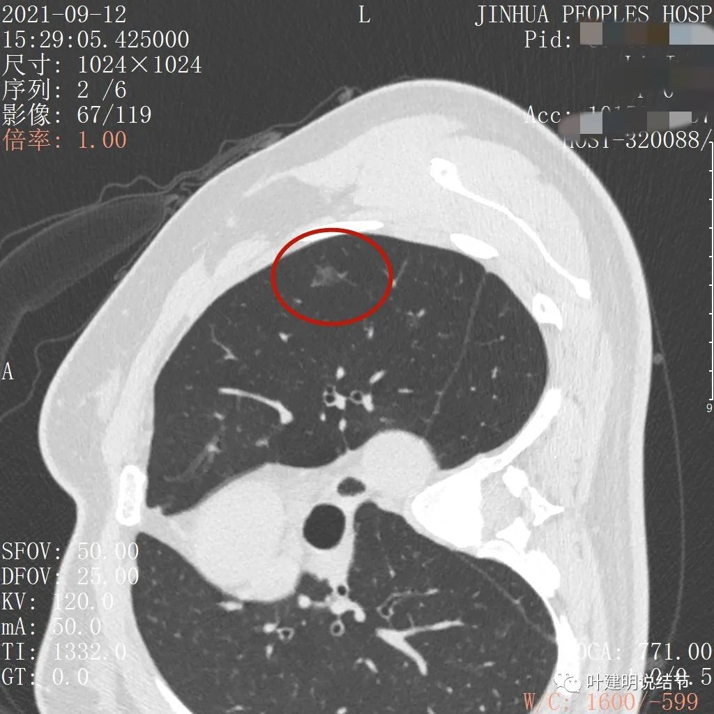 怎样从病理报告看是不是原位癌,原位腺癌切除子宫要开刀吗