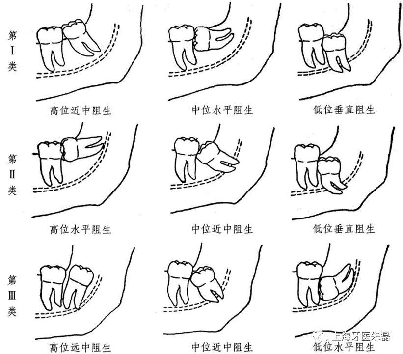 什么是阻生智齿需要拔吗,什么是阻生齿与智齿区别
