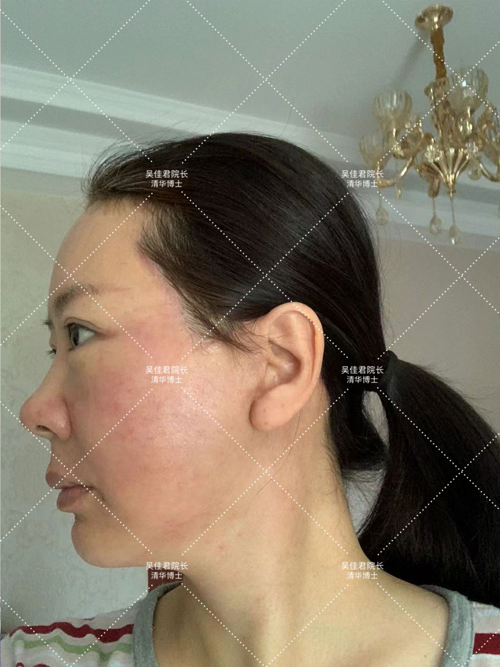 54岁姐姐分享大拉皮术后恢复历程,48岁做拉皮手术的真实经历