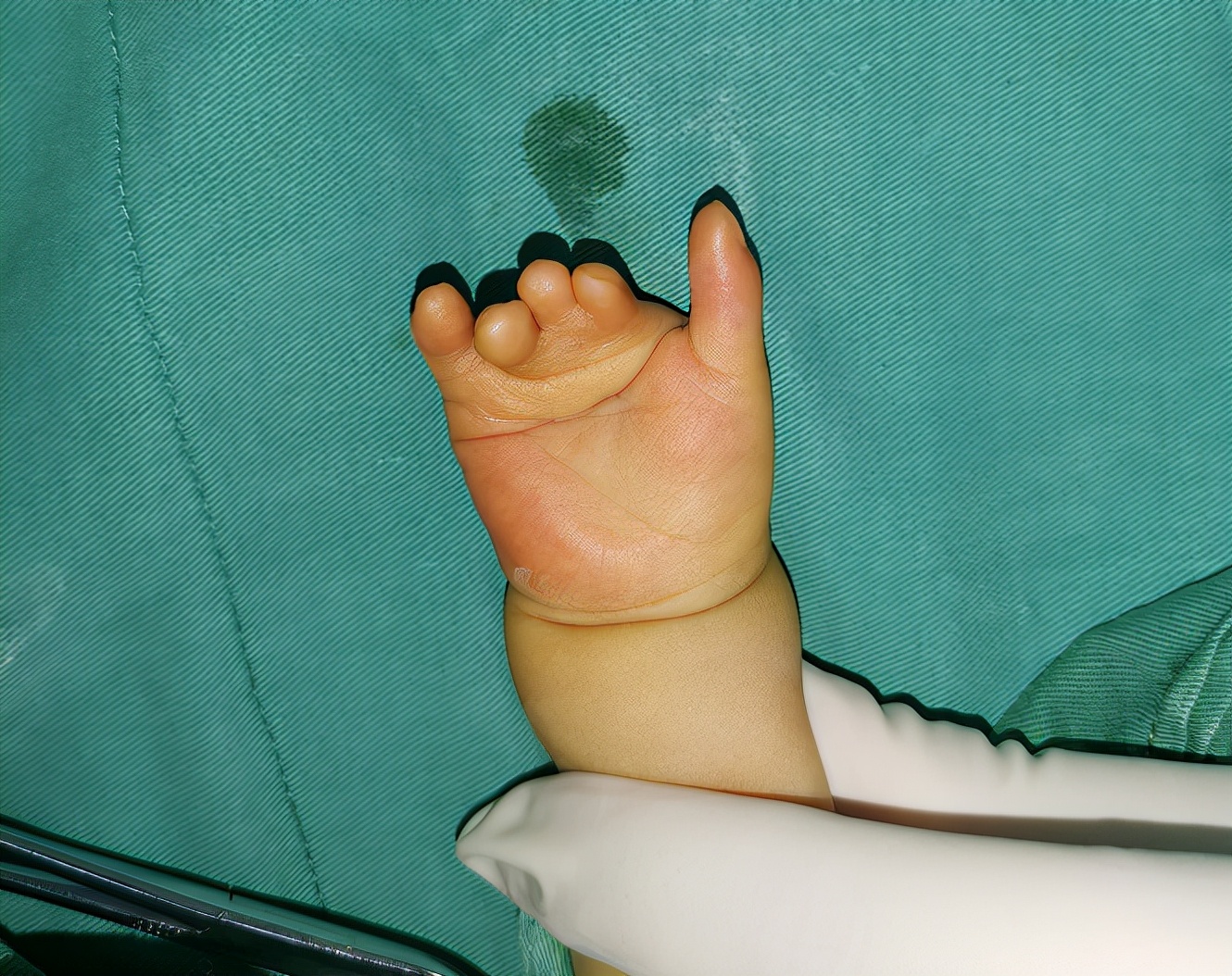 并指畸形免植皮案例,并指畸形