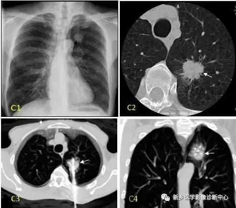 肺部有球形病灶怎么治疗,肺内多发结节诊断早期肺癌怎么办