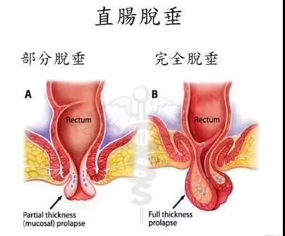 “医生，我肛门里长出了小尾巴，是啥东西？”这5种情况了解下
