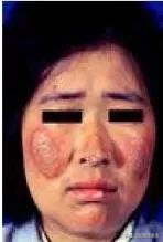 「免疫相关不良妊娠答疑解惑52」——妊娠期高血压疾病