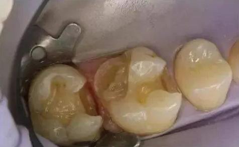 根管治疗后的牙齿能使用多久？听听良心牙医怎么说