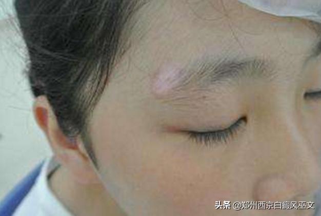 儿童白斑误诊为白癜风,小儿白癜风和局限性白癜风症状