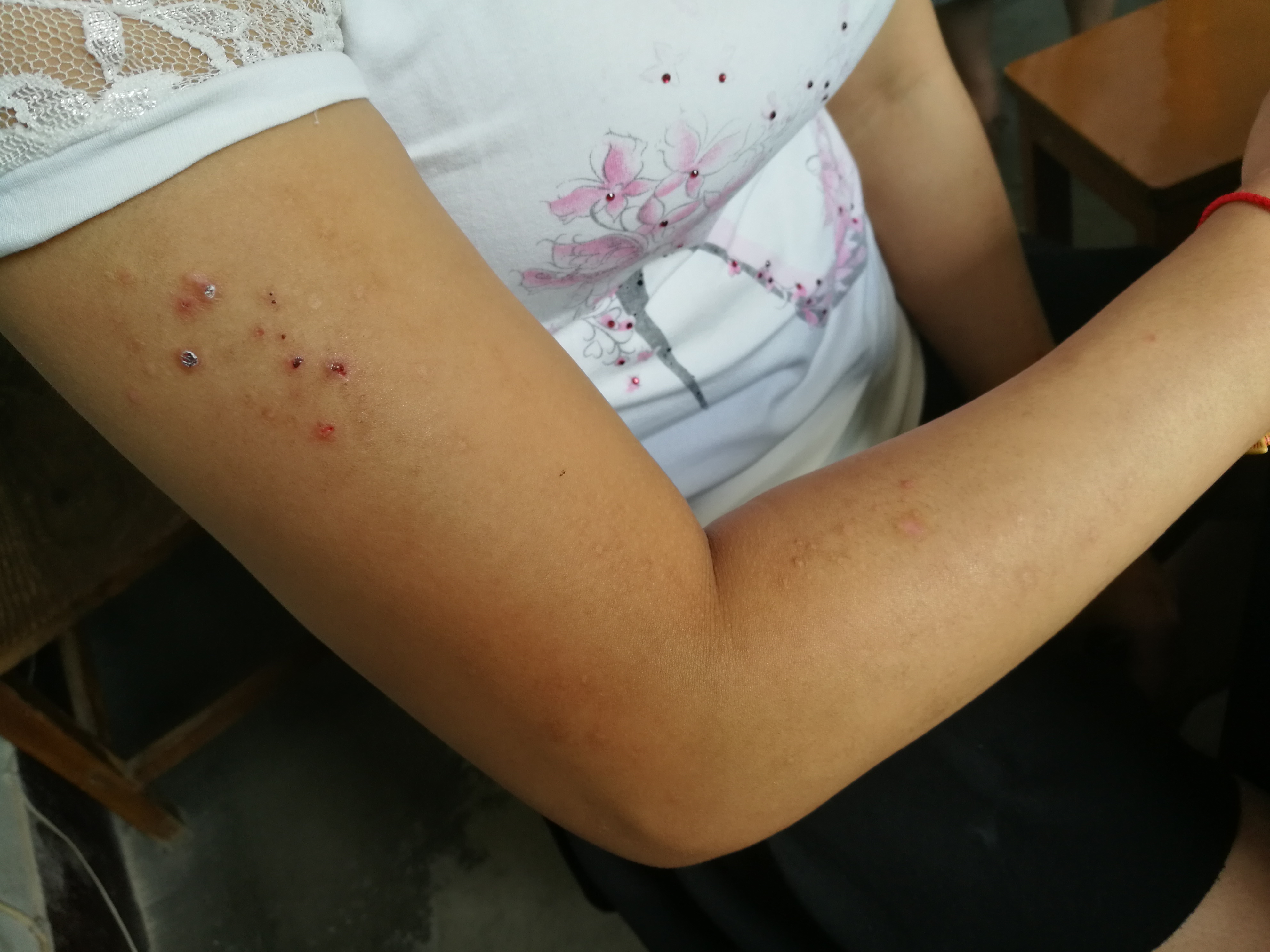 光过敏/多形性日光疹