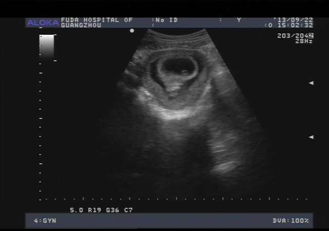 产检胎儿出生了,产检发现怀孕双胞胎