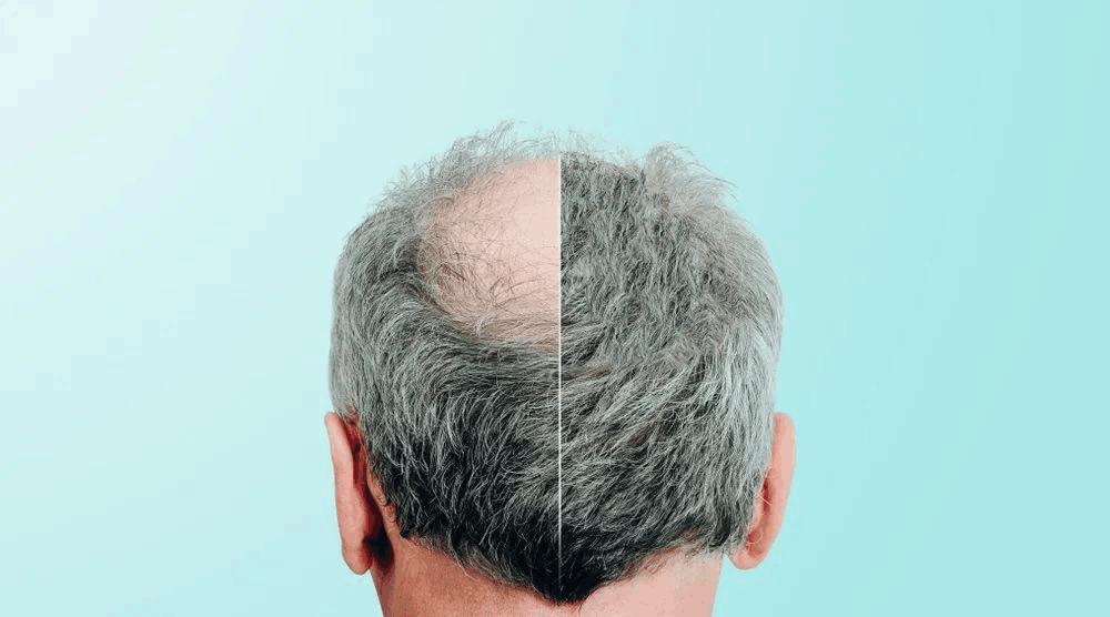 头屑多掉头发严重什么原因,头屑多掉头发是什么原因