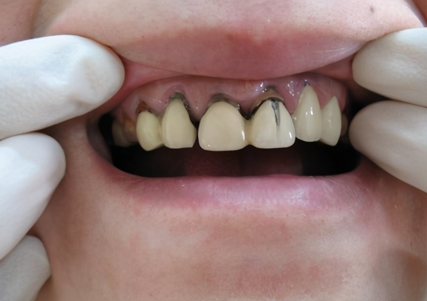 牙齿缺失该不该戴假牙,牙齿缺失要不要种牙