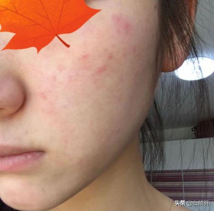 红肿硬块痘痘没有脓怎么快速消退,红肿痘痘不疼了但是还是有包