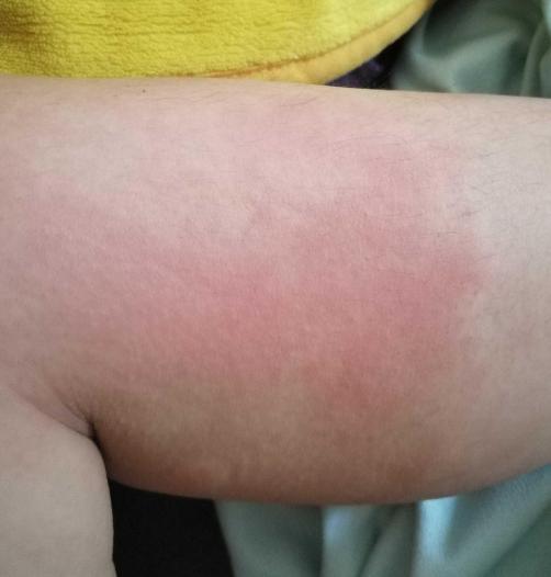 儿童解决皮肤干燥的最好方法,孩子皮肤干燥用什么保湿霜