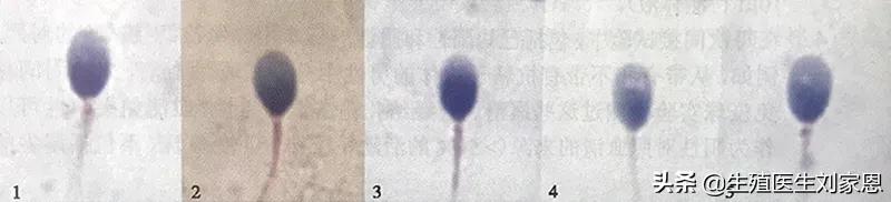 精子畸形率高有办法治吗,精子畸形率高是否容易生畸形儿